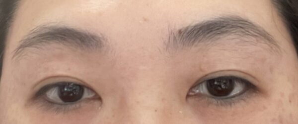 乾眼症是一種常見的眼部疾病,尤其在現代辦公環境中尤為普遍。圖/資料庫