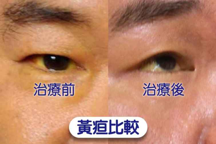 ▲林先生治療接近兩周，黃疸症狀逐漸消退，但眼白依然看得到黃色。（台中慈濟醫院提供）