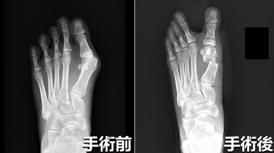 天天穿高跟鞋變痛痛腳！ 小模一脫鞋「大拇趾卡死」得手術 243
