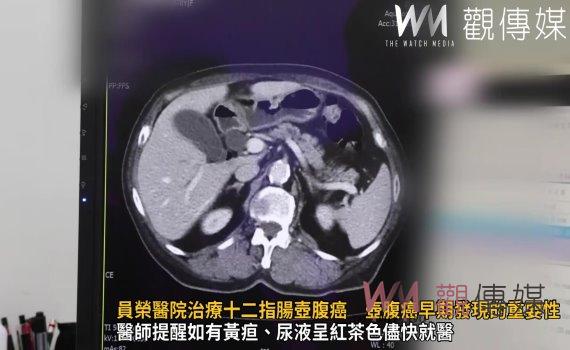 (有影片)/員榮醫院治療十二指腸壺腹癌 壺腹癌早期發現的重要性