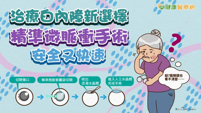 治療白內障新選擇 精準微脈衝手術安全又快速