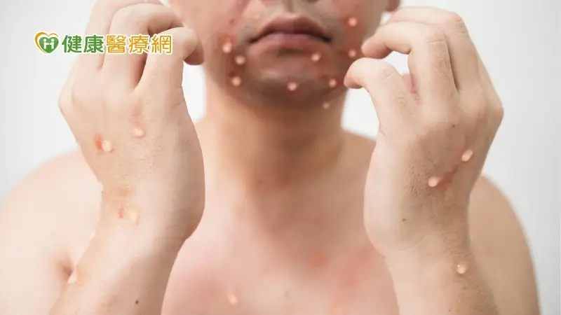 暑假將至出國旅遊小心M痘! 1男與外國網友親熱一夜染M痘痛到睡不著