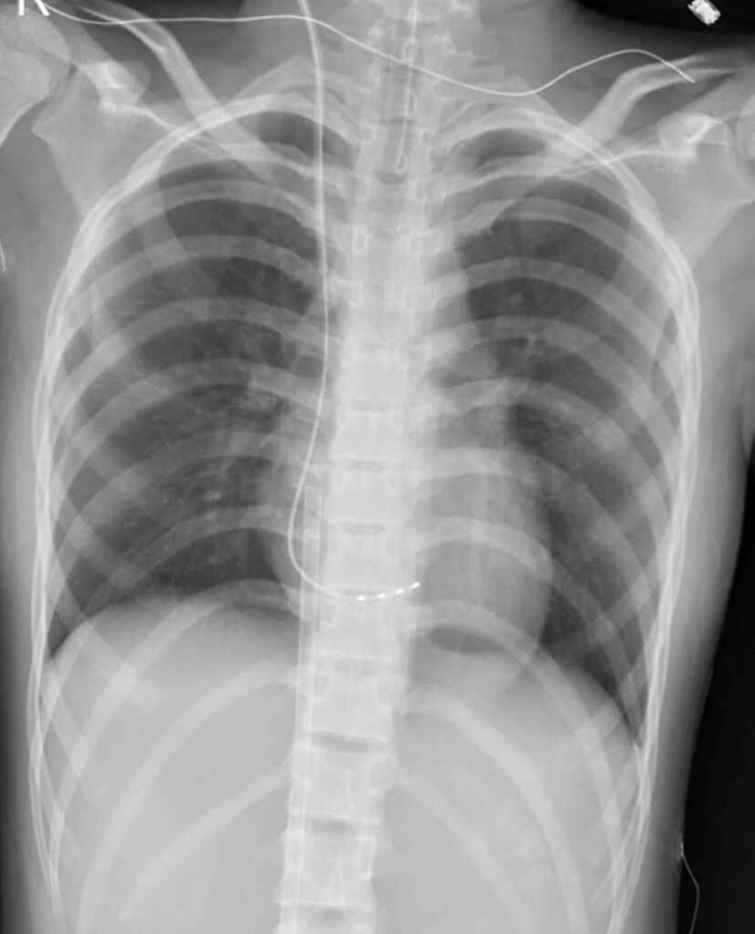 ▲戴以信醫師在小涵的右心室放置導線進行過速激發（overdrive pacing），以更快速的節律來終止心室頻脈。（中醫大兒醫提供）