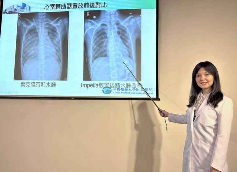 ▲吳佳穎醫師指出，原使用傳統葉克膜急救，突引發肺水腫及雙腳發黑等嚴重併發症(左)，醫療團隊討論後，決定讓劉姓少女改以微型心臟幫浦(右)治療，便順利改善併發症症狀。（中醫大附醫提供）
