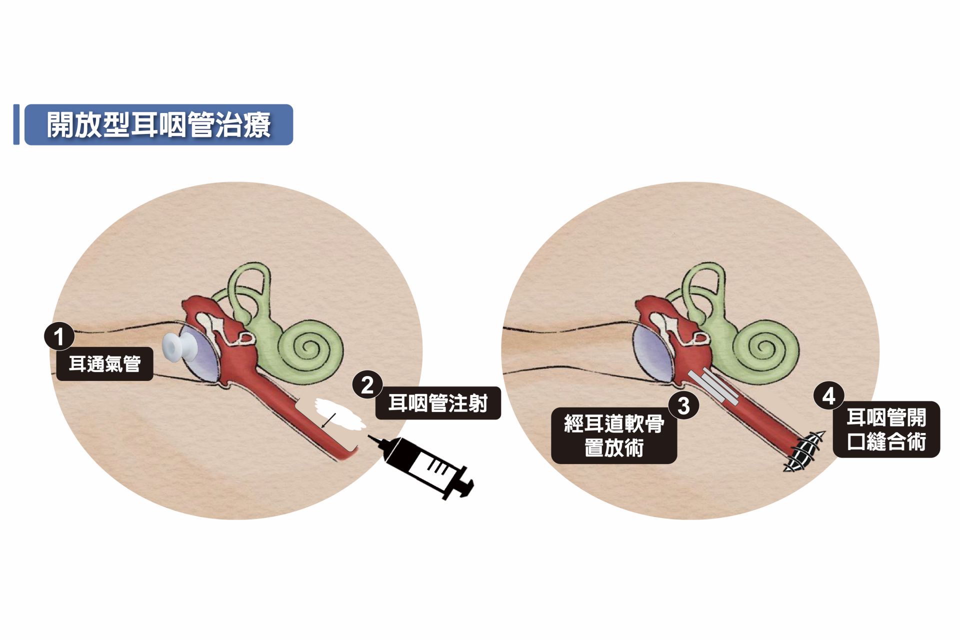 開放型耳咽管治療示意圖。