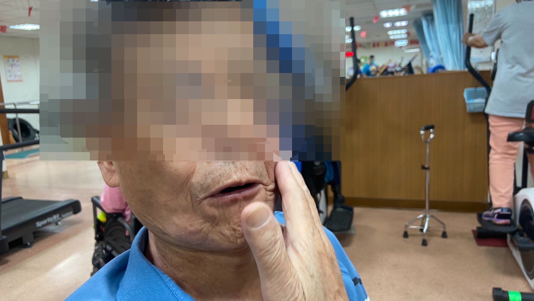▲70多歲男子因10多年前鼻咽癌接受放療後，臉頰及喉部肌肉維維化，將臉頰及喉部的肉切除。（員榮醫院提供）