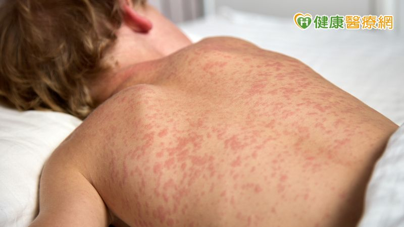 1人感染會傳染給18人! 減少麻疹傳播,醫籲「1預防方式」最有用