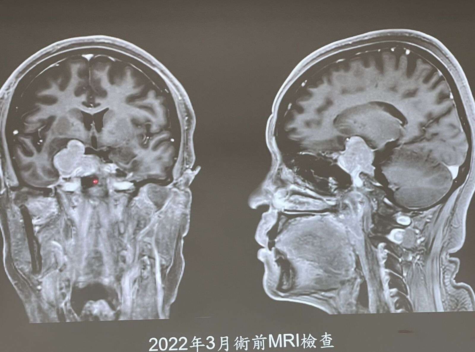 嚇壞!騎車一半「眼前事物全歪斜」 原來4公分腫瘤壓眼險失明 216 嚇壞!騎車一半「眼前事物全歪斜」 原來4公分腫瘤壓眼險失明 215