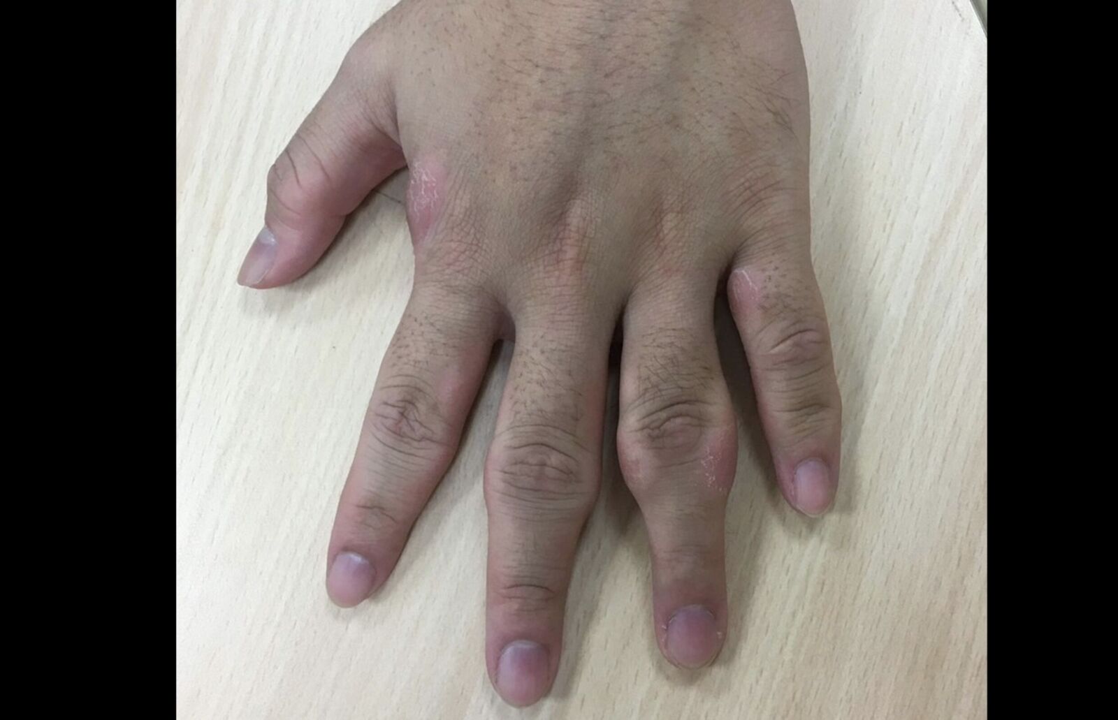閒來無事折手指!22歲男學生手指莫名腫大 竟罹罕見「指部厚皮症」 216 閒來無事折手指!22歲男學生手指莫名腫大 竟罹罕見「指部厚皮症」 215