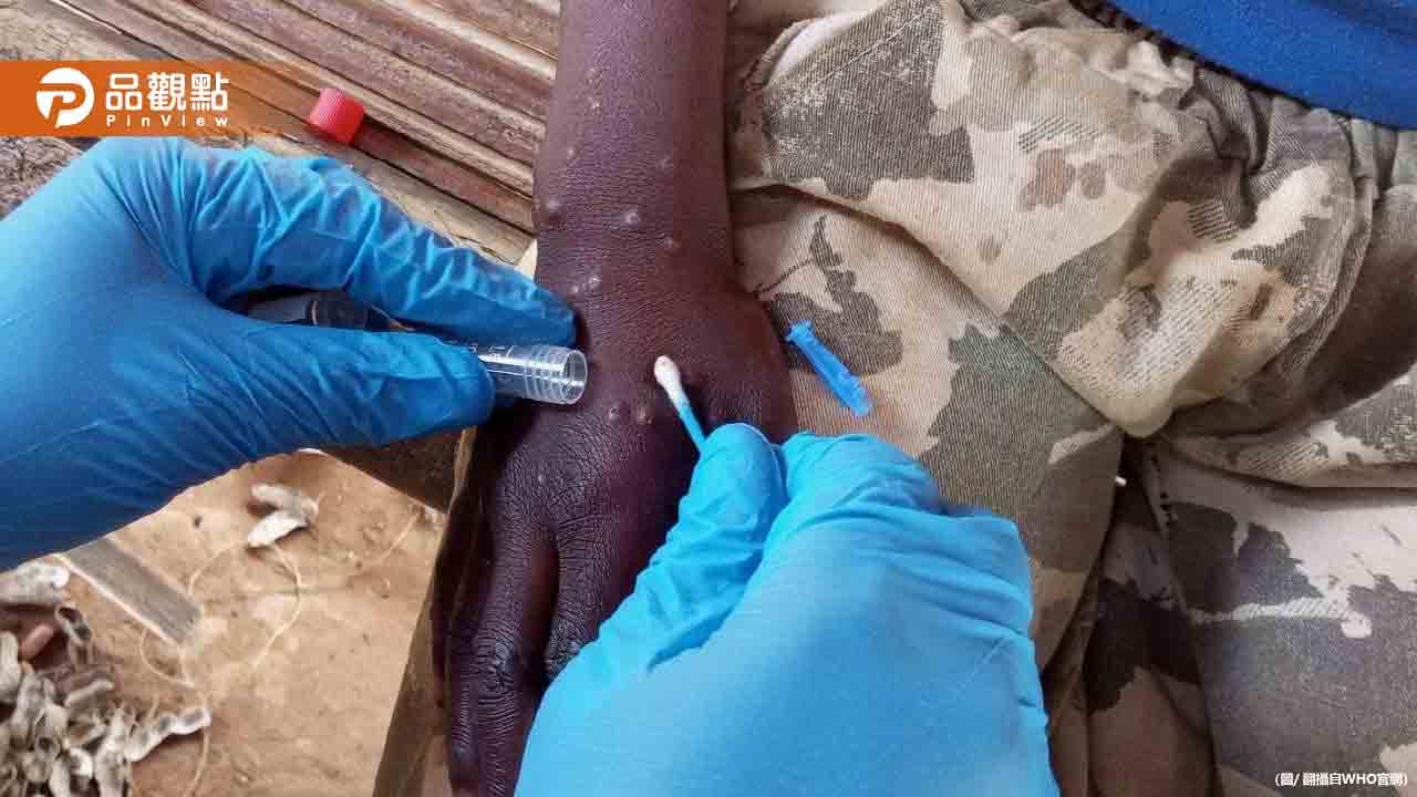 變種M痘肆虐越南胡志明市！「3類人」高風險
