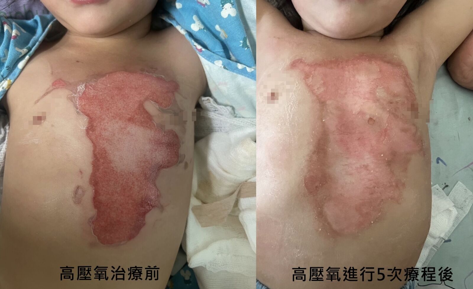 2歲童掀翻熱湯「胸口大面積燙傷」 媽媽抱進高壓氧艙促長新皮 184 2歲童掀翻熱湯「胸口大面積燙傷」 媽媽抱進高壓氧艙促長新皮 183