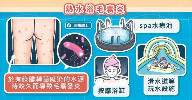 熱水浴毛囊炎是什麼?