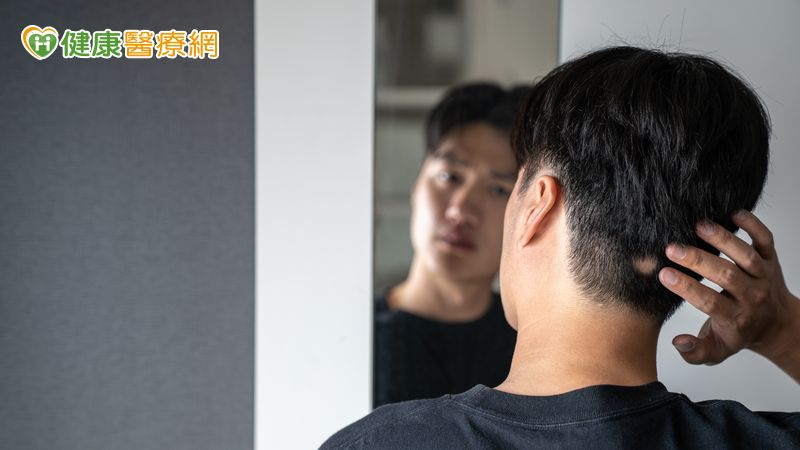 鬼剃頭是壓力引起?皮膚科醫師揭圓禿真相及治療對策