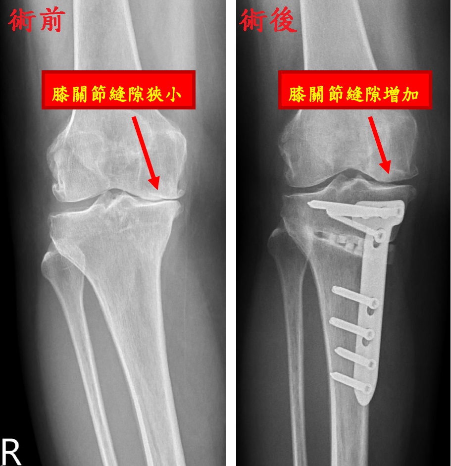 陳威仁醫師表示,高位脛骨矯正手術前需X光及3D掃描,精確計劃後進行切割與固定,矯正O型腿,分散壓力,減輕疼痛並延長膝關節壽命。(圖/記者林照東翻攝)