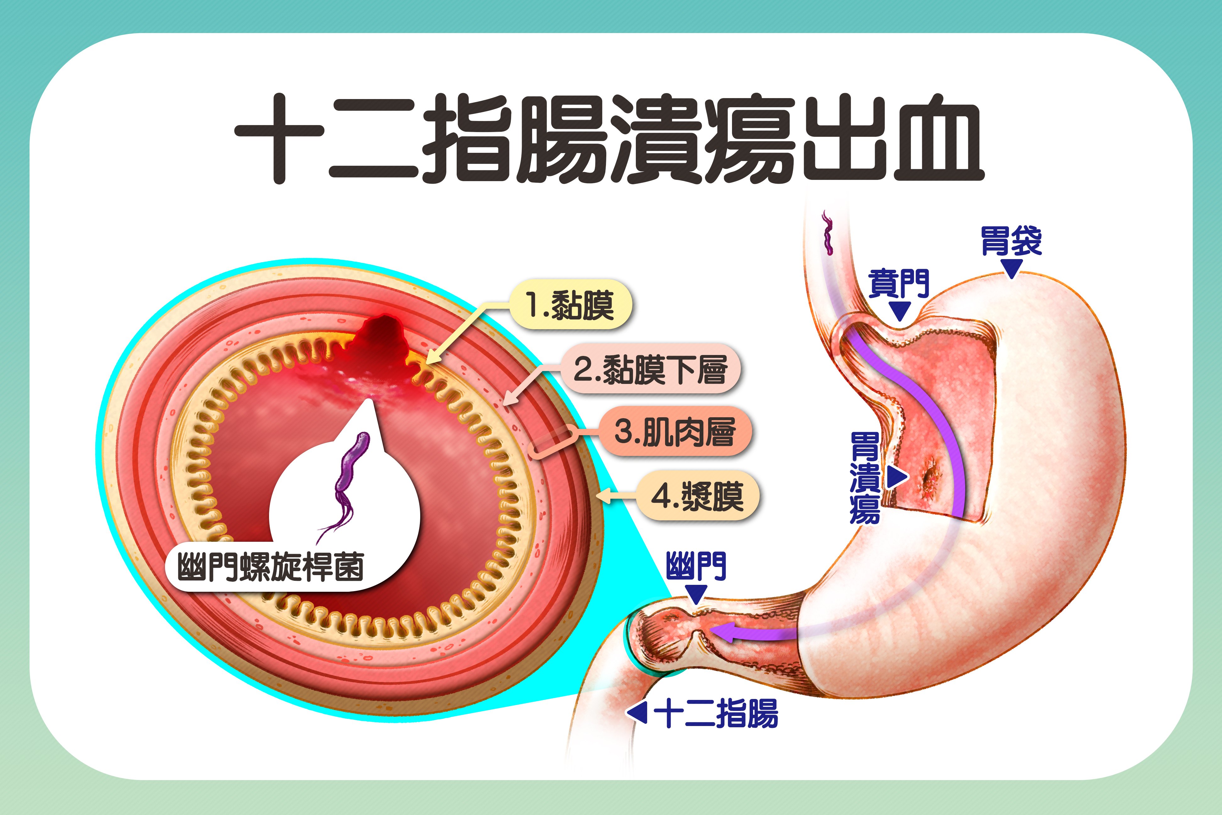 幽門螺旋桿菌經由糞、口傳播,能生存在酸性環境引發黏膜發炎、潰瘍,進而導致癌症。