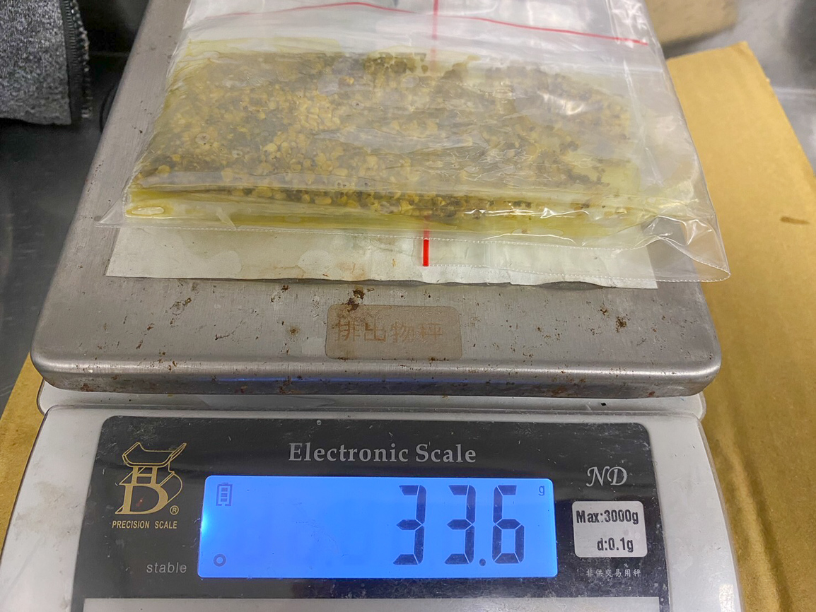 ▲博田國際醫院肝膽胰外科副院長李金德教授為女工程師進行的膽囊切除手術，取出的膽結石重量為33.6公克。（圖/博田國際醫院提供）