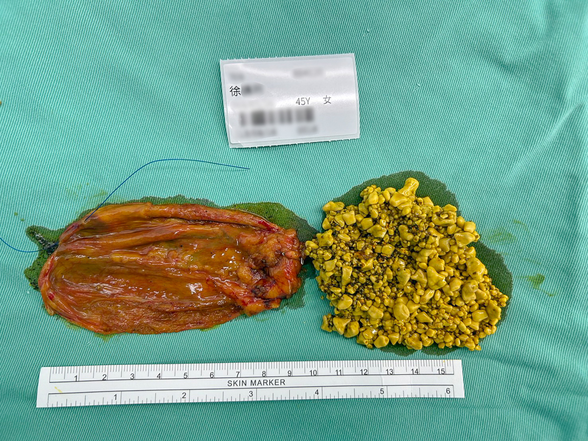 ▲45歲女工程師長期腸胃不適，南下尋求博田國際醫院肝膽胰外科救治，副院長李金德教授為其進行膽囊切除手術，膽囊佈滿逾3千顆大小不一的膽結石。（圖/博田國際醫院提供）