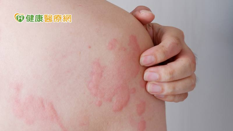 皮膚反覆紅腫癢逾「這時間」可能是慢性自發性蕁麻疹! 治療謹記3要1不