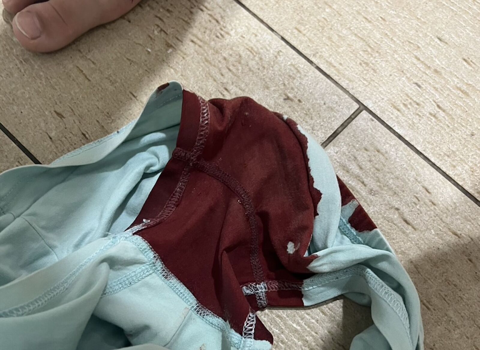 6歲男童「大量血便染紅褲」 事前不痛沒徵兆!竟是克隆氏症 260 6歲男童「大量血便染紅褲」 事前不痛沒徵兆!竟是克隆氏症 259