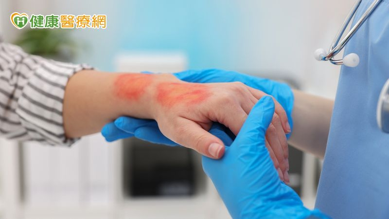 奇美「住院燒燙傷病人病情預測」系統隨時掌握病人概況 疾病進展無漏失