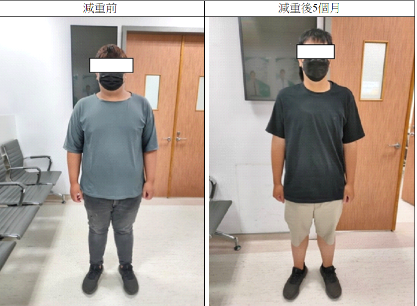 縮胃曠腸 減重手術 榮總