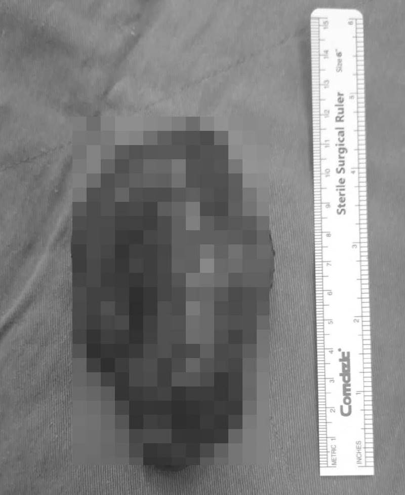 ▲病患胸腔有一顆約13公分且鈣化的甲狀腺腫瘤，經手術成功移除。（仁愛長庚醫院提供）