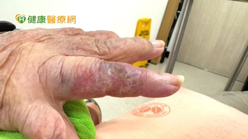 手指斑塊以為濕疹!一查竟是「皮膚癌」 94歲嬤不易手術用1治療改善