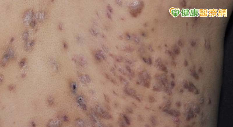 易與青春痘混淆的「化膿性汗腺炎」醫授3招自我檢測