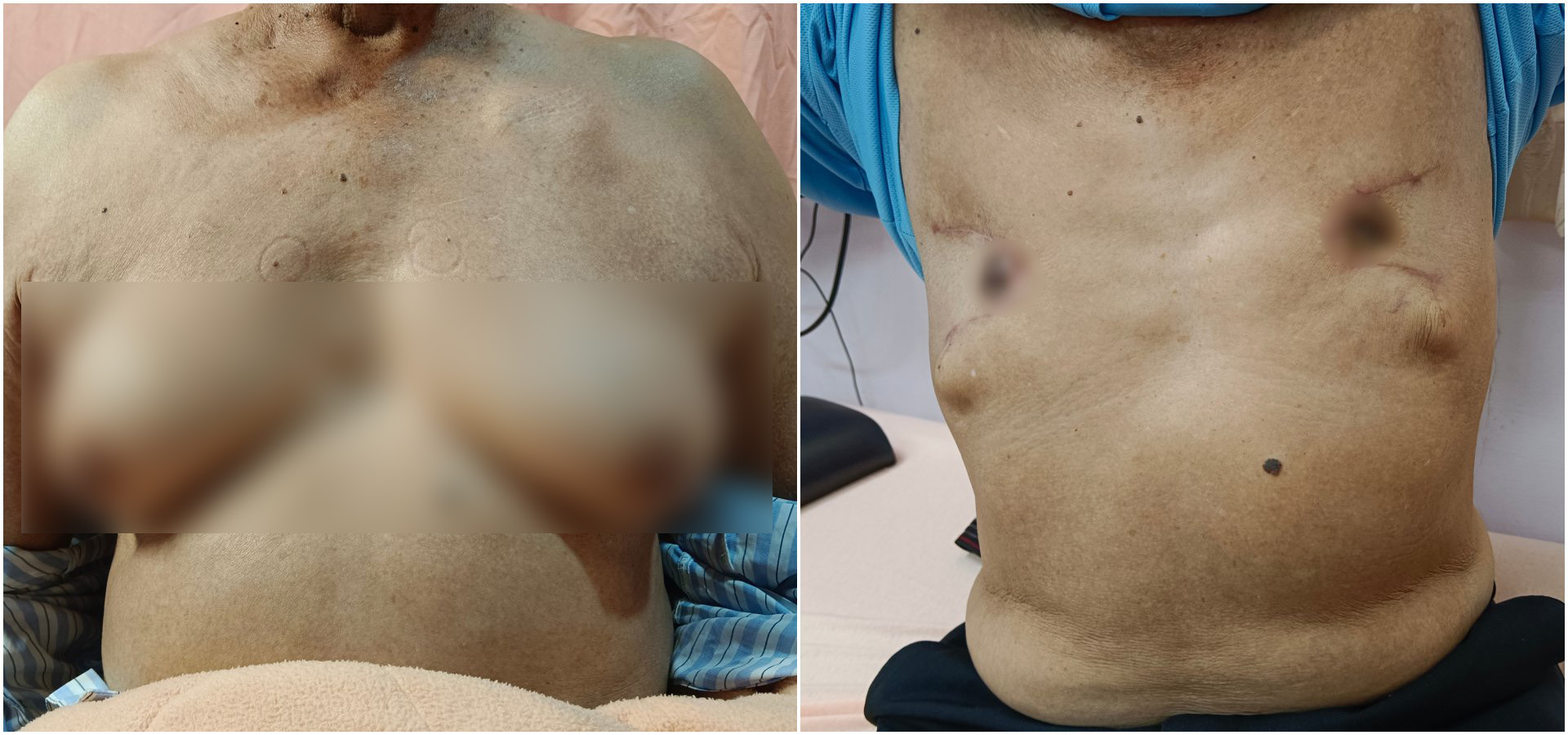 (左圖)年近八旬病人,兩側乳房疼痛約一個月,到花蓮慈濟醫院乳房醫學中心吳柏鋼醫師門診,經檢查診斷為第四級「男性女乳症(Gynecomastia)」。<br/>(右圖)病人手術切除後恢復身材,男性女乳症是男性常見的乳房問題,建議男性朋友一旦出現類似症狀時,可到花蓮慈院乳房醫學中心門診檢查,早期診斷早期治療。