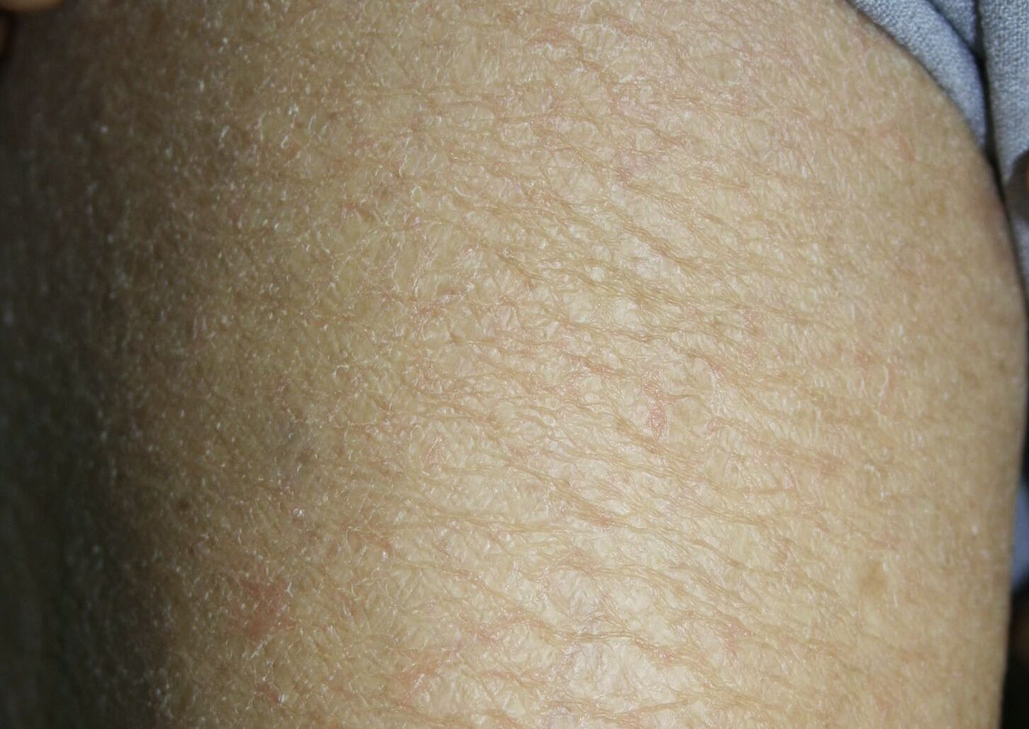 不時全身發癢?六大皮膚問題常找老人 臀部「黑黑粗粗的」竟是椅子坐太硬 230 不時全身發癢?六大皮膚問題常找老人 臀部「黑黑粗粗的」竟是椅子坐太硬 229