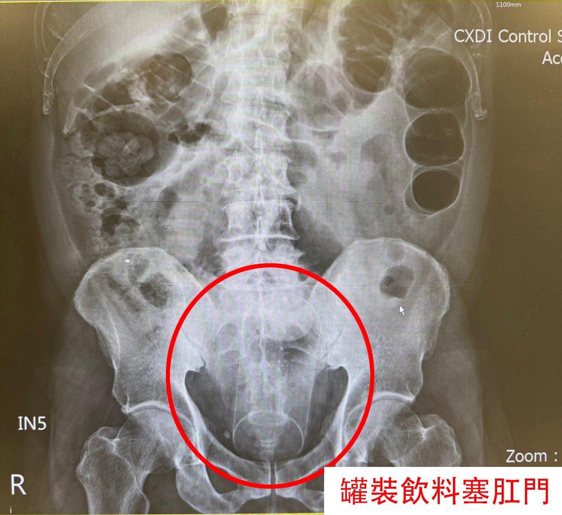 一名50歲男子三天無法排便、腹痛,就醫檢查發現肛門內卡著13公分長的罐裝飲料。(圖/記者林照東翻攝)