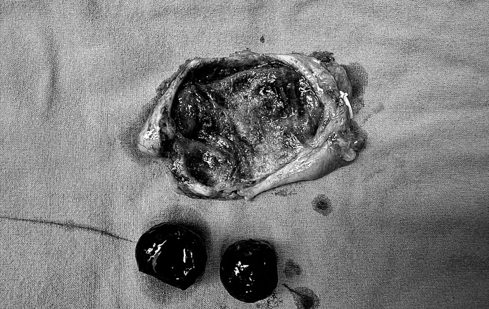 她大嗑火鍋後狂痛 切開膽囊驚見兩顆「黑色大粉圓」作怪 215