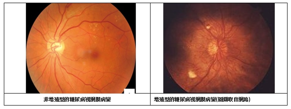 糖尿病影響眼健康 醫師呼籲定期檢查防視力損傷