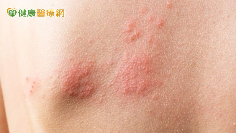 身體突冒多顆水皰,小心是染「這1病毒」 醫籲:接種疫苗增保護力