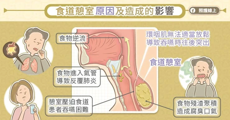 食道憩室的原因