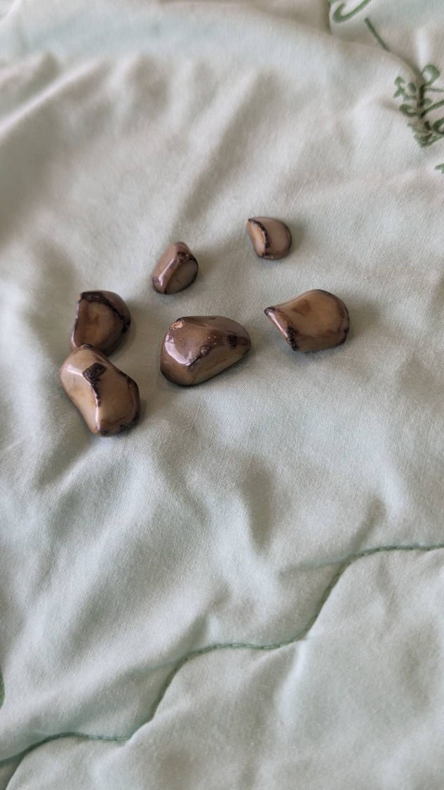病患的膽道異常導致膽結石風險增加,膽囊管錯誤連接至右側肝管。選擇3D微創手術成功切除膽結石,未引發併發症。(圖/記者林照東翻攝)