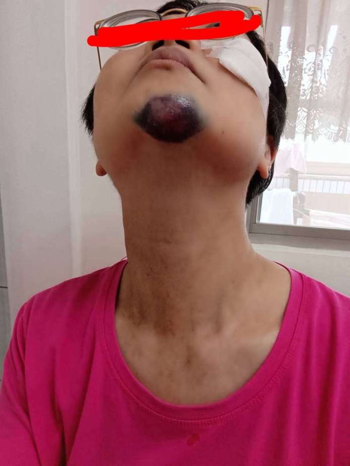 婦參加活動慘摔鼻青臉腫 承包廠商遭質疑態度惡劣 18 S 64479257 0