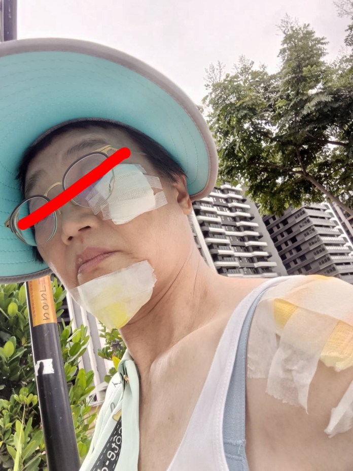 婦參加活動慘摔鼻青臉腫 承包廠商遭質疑態度惡劣 19 S 64479255 0
