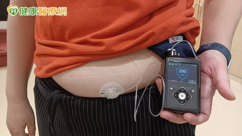 科技控糖「雙管齊下」 糖尿病患生活不再受限
