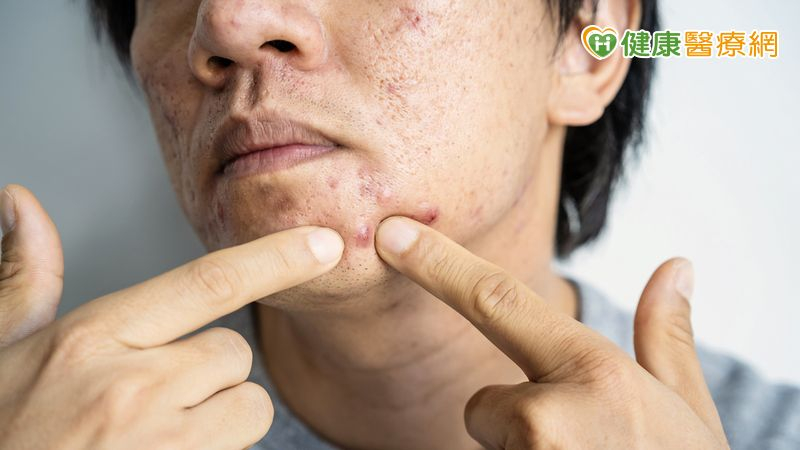 他連吃三天羊肉爐痘痘爬滿臉 醫列進補注意事項:「這些人」注意