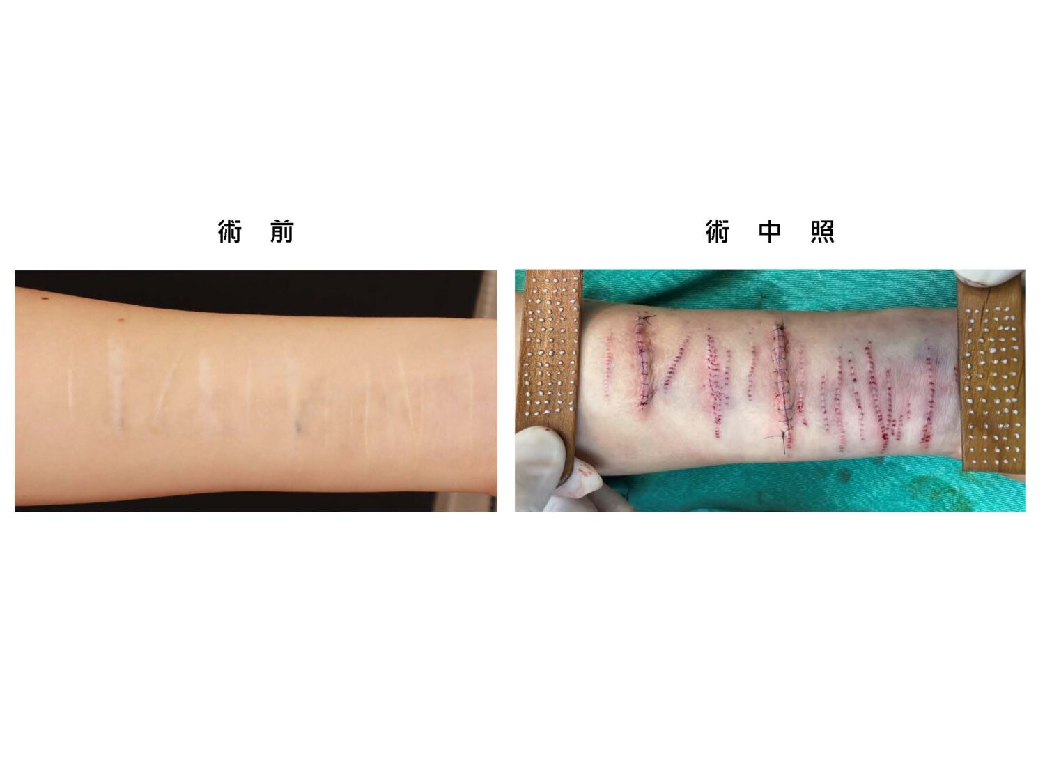 去除白疤展現新人生!香港靚女「棄中來台」求助「白疤之父」