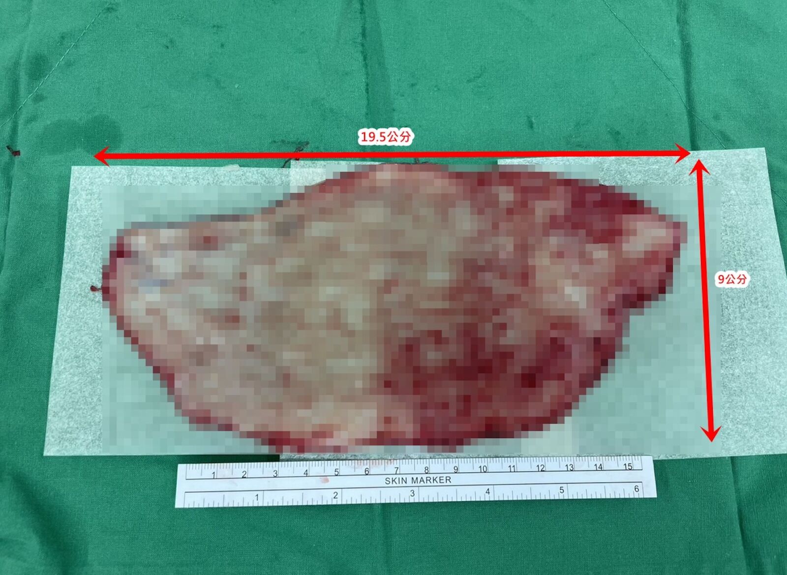 她慘遭機車「掀開整片大腿皮」血肉淋漓！ 醫師巧手種回全層皮膚 221