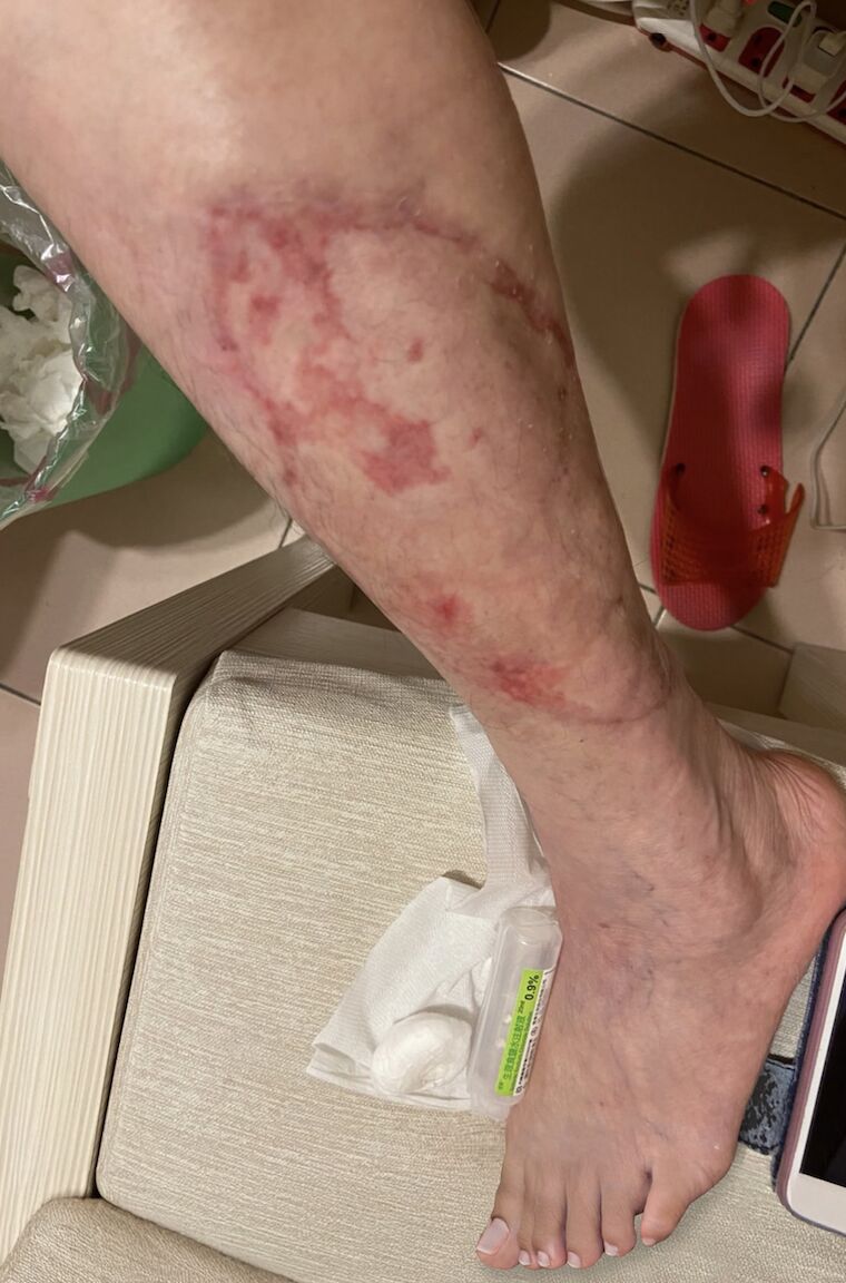 她慘遭機車「掀開整片大腿皮」血肉淋漓! 醫師巧手種回全層皮膚 224 她慘遭機車「掀開整片大腿皮」血肉淋漓! 醫師巧手種回全層皮膚 223