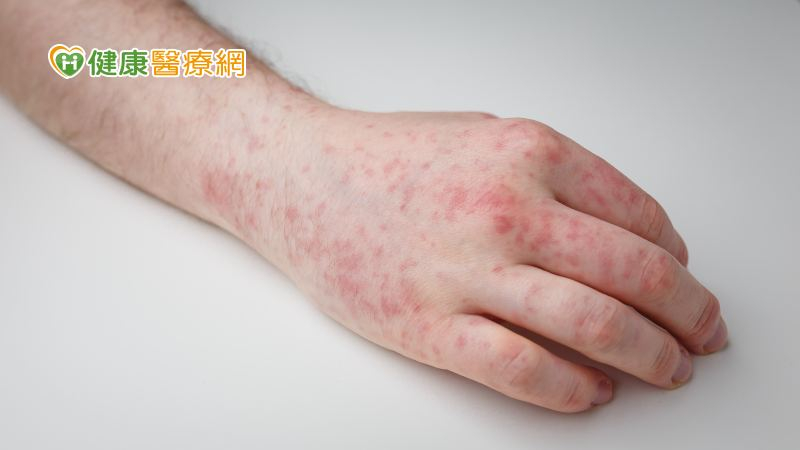 麻疹病例數創5年同期新高!本土再+1接觸者逾百人 感染源不明仍需調查