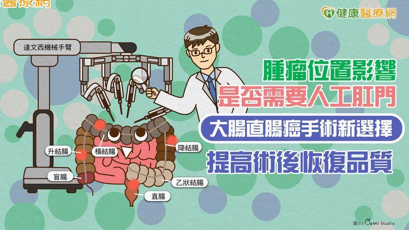 腫瘤位置影響是否需要人工肛門 大腸直腸癌手術新選擇 提高術後恢復品質