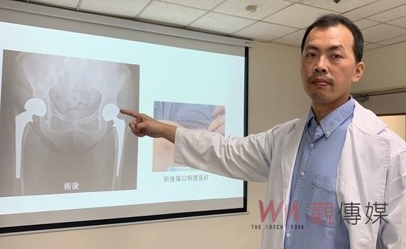 半年內接連摔斷兩腿 這手術讓她行動自如繼續拈花惹草