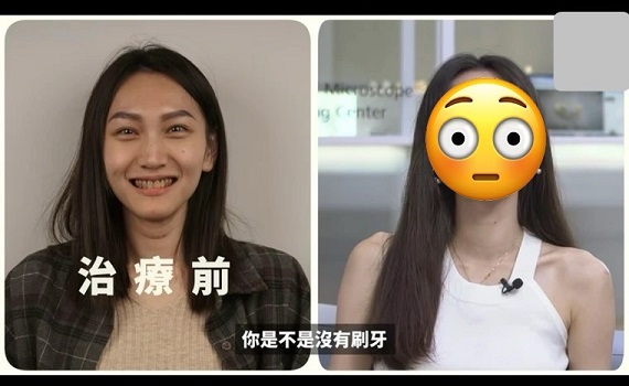 妙齡女整牙後「驚人對比」曝光！網驚：巫婆變女神