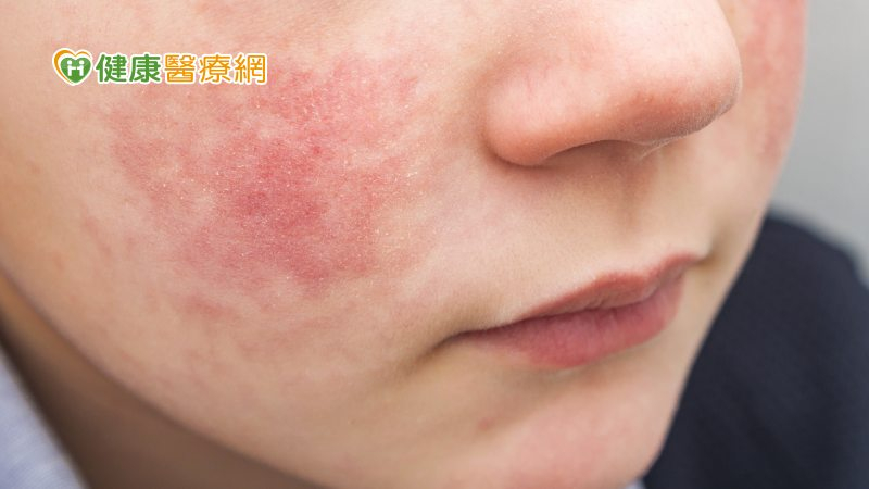 日本「蘋果病」病例數激增! 國內是否受影響?哪些高危險族群需注意?