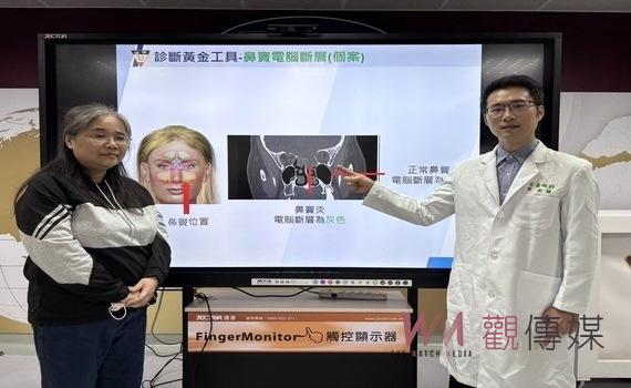 單側頭痛眼睛痛逾2個月 鼻竇腫瘤惹得禍