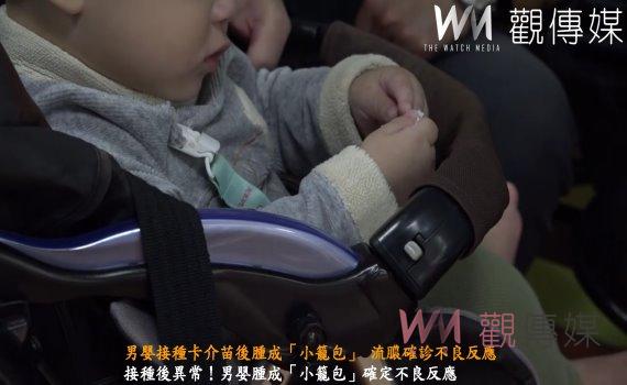 (有影片)/男嬰接種卡介苗後腫成「小籠包」 流膿確診不良反應!